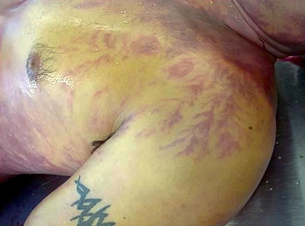 El Servicio Meteorológico Nacional advierte que los rayos pueden transmitirse por tuberías y causar lesiones graves. Conoce qué hacer para protegerte. El Servicio Meteorológico Nacional advierte que los rayos pueden transmitirse por tuberías y causar lesiones graves. Conoce qué hacer para protegerte.