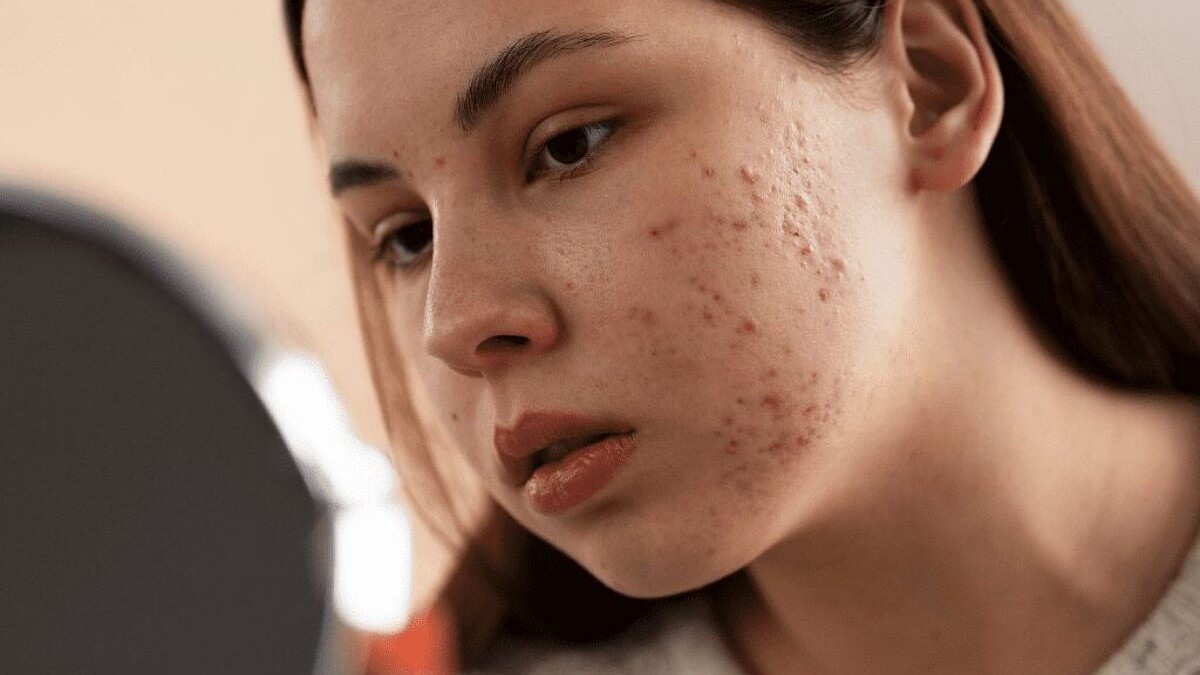 Dermatólogo alerta sobre automedicación y tendencias virales que agravan el acné Dermatólogo alerta sobre automedicación y tendencias virales que agravan el acné