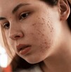 Dermatólogo alerta sobre automedicación y tendencias virales que agravan el acné Dermatólogo alerta sobre automedicación y tendencias virales que agravan el acné