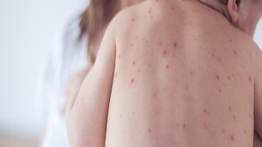 ntre los síntomas característicos de la varicela se encuentran fiebre