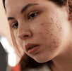 Dermatólogo alerta sobre automedicación y tendencias virales que agravan el acné