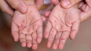 Con 29 brotes en menos de un año, Puebla se posiciona como una de las entidades más afectadas por el contagio del virus Coxsackie.