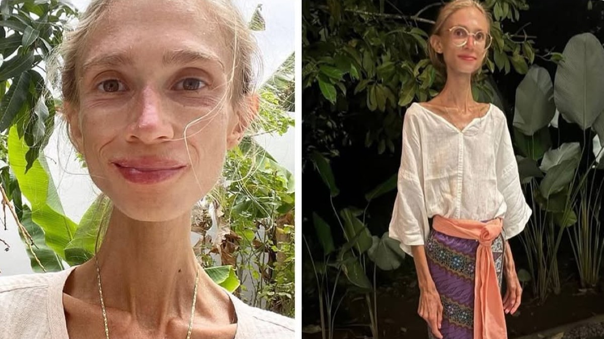 Una joven llamada Karolina Krzyzak, de tan solo 27 años, falleció en su habitación de hotel a causa de la desnutrición, pesando apenas 22 kilos.
