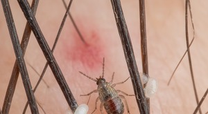 Los piojos pueden actuar como vectores de enfermedades graves que se propagan a través de sus heces o cuando son aplastados sobre la piel infectada.
