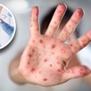 La vacuna SRP, que protege contra el sarampión, rubéola y parotiditis, está disponible de manera gratuita en Guanajuato. La vacuna SRP, que protege contra el sarampión, rubéola y parotiditis, está disponible de manera gratuita en Guanajuato.