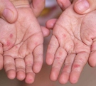 Con 29 brotes en menos de un año, Puebla se posiciona como una de las entidades más afectadas por el contagio del virus Coxsackie.