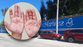 Fachada de escuela en Tehuacán, Puebla y manos con síntomas del virus coxsackie.
