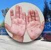 Fachada de escuela en Tehuacán, Puebla y manos con síntomas del virus coxsackie. Fachada de escuela en Tehuacán, Puebla y manos con síntomas del virus coxsackie.