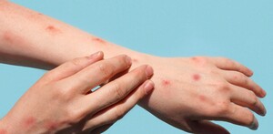 Sarampión síntomas y cómo se contagia. Sarampión síntomas y cómo se contagia.