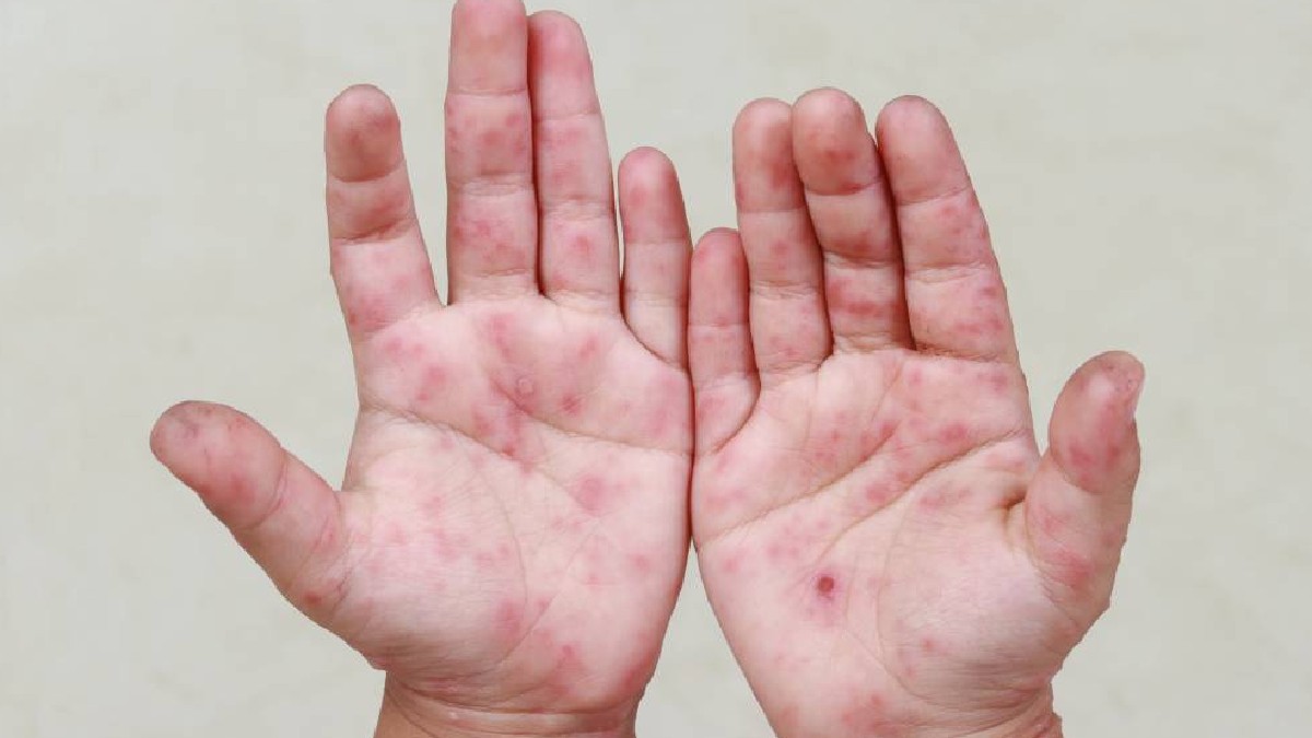 Manos de un menor con el virus Coxsackie. Manos de un menor con el virus Coxsackie.