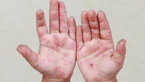 Manos de un menor con el virus Coxsackie.