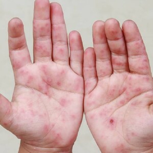 Manos de un menor con el virus Coxsackie.