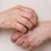 Brazos de menor de edad marcados por ronchas de sarampión Brazos de menor de edad marcados por ronchas de sarampión