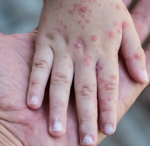 Mano de un adulto sosteniendo la mano de un niño infectado con Coxsackie que presenta erupciones y ampollas provocadas por el virus Mano de un adulto sosteniendo la mano de un niño infectado con Coxsackie que presenta erupciones y ampollas provocadas por el virus