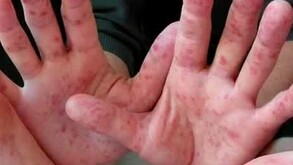 Manos y pies infectadas por Coxsackie, virus que ha causado alarma en México
