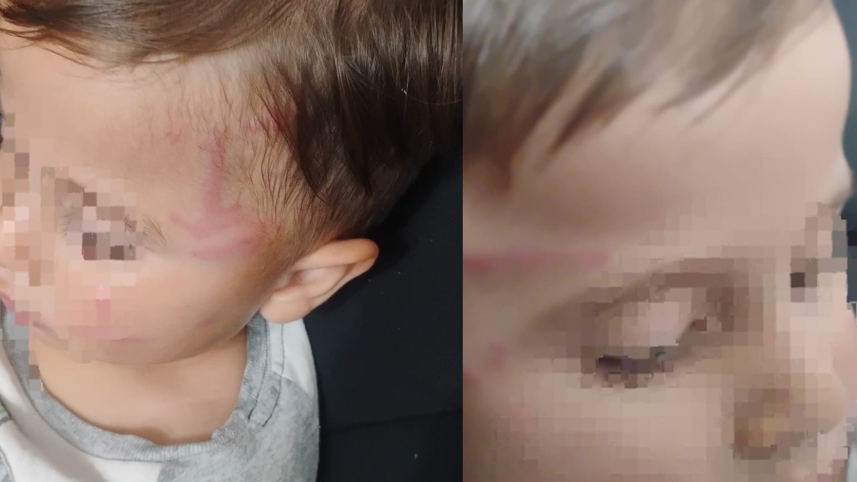 Niño de apenas 2 años con mordeduras y rasguños provocados por un perro tras atacarlo en Torreón. Niño de apenas 2 años con mordeduras y rasguños provocados por un perro tras atacarlo en Torreón.