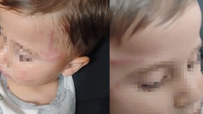 Niño de apenas 2 años con mordeduras y rasguños provocados por un perro tras atacarlo en Torreón.