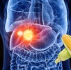 Ilustración médica: se ve el hígado dentro de la silueta del cuerpo, mostrando un tumor iluminado. Un par de elotes o choclos (maíz) se superponen a la imagen Ilustración médica: se ve el hígado dentro de la silueta del cuerpo, mostrando un tumor iluminado. Un par de elotes o choclos (maíz) se superponen a la imagen