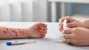 Primer plano de un brazo de niño con sarpullido rojo (simulando sarampión o varicela). Un termómetro está cerca y manos adultas sostienen un pañuelo de papel en