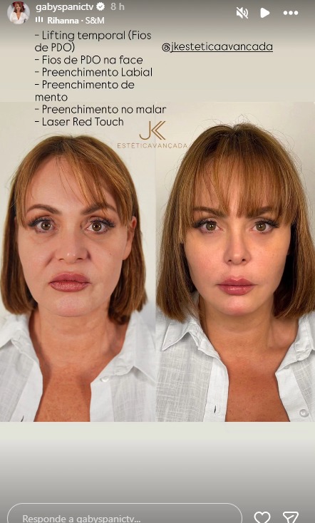 Gaby Spanic, comparte en historias de Instagram los cambios que se realizó en el rostro.