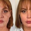 Gaby Spanic antes y después de someterse a una serie de procedimientos estéticos en la cara.