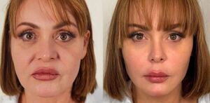 Gaby Spanic antes y después de someterse a una serie de procedimientos estéticos en la cara.