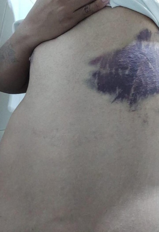 Un hombre con el torso desnudo mostrando un moretón de gran tamaño en su cuerpo.