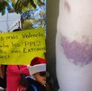 Imagen de una persona con un moretón en el cuerpo junto a una protesta en el municipio de Tehuacán.