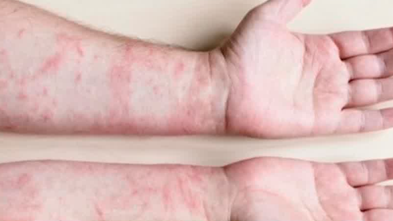 A 301 días de la alerta epidemiológica, México acumula 5 mil 580 casos confirmados de sarampión en 29 entidades y 24 defunciones.