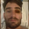 Hombre identificado como Ignacio Leiva viendo de frente con uno de los ojos herido y censurado mientras está en la cama de un hospital
