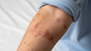 el brazo de una persona contagiada de sarampión