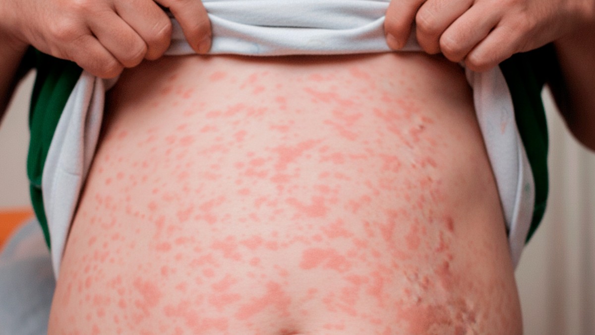 Persona con brote de sarampión en la parte del estómago.