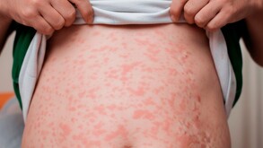 Persona con brote de sarampión en la parte del estómago.