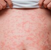 Persona con brote de sarampión en la parte del estómago.