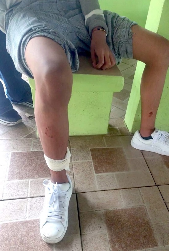 Persona con heridas por mordedura de perro pitbull en Veracruz.