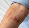 el brazo de una persona contagiada de sarampión