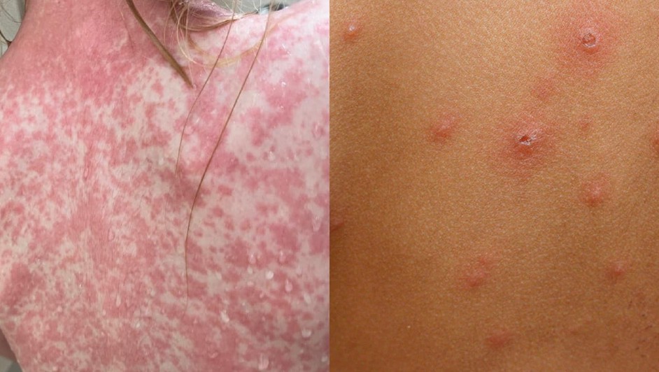 Caso de sarampión (izquierda) y caso de varicela (derecha)