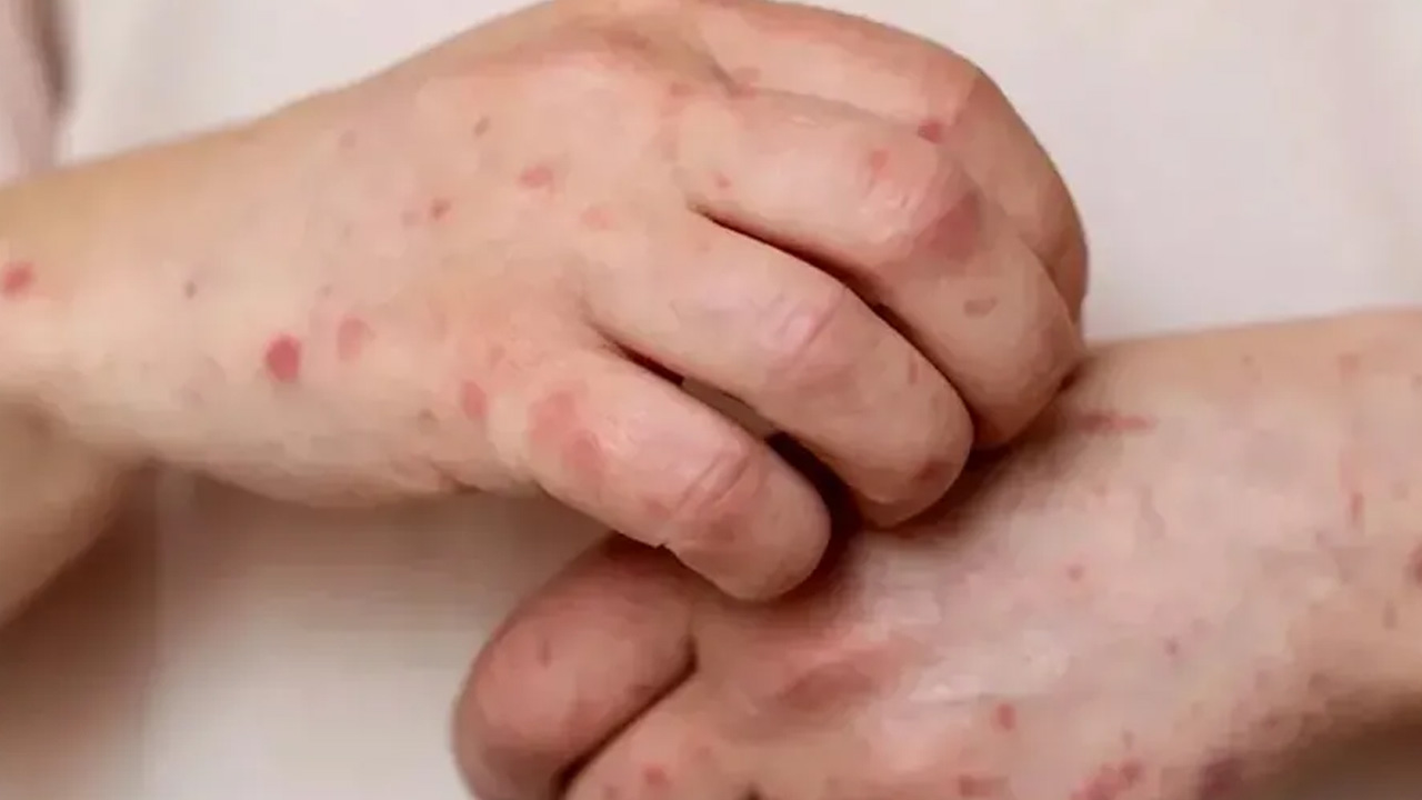 La Facultad de Medicina de la UNAM informó sobre la detección de un caso sospechoso de sarampión en el grupo 2216.