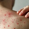 Persona vista de espaldas rascándose ronchas rojas de sarampión en los hombros