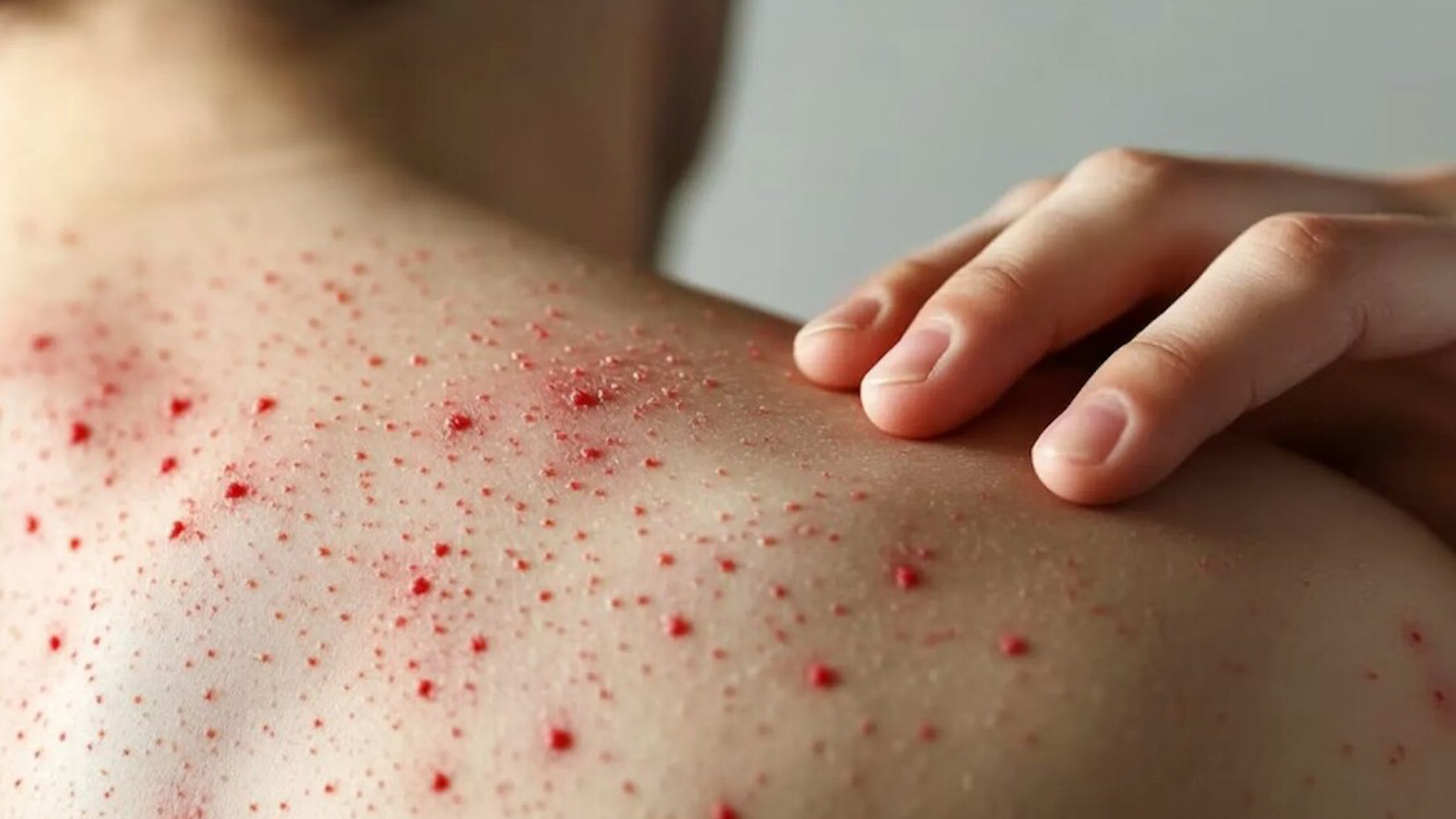 Se requieren dos dosis: a los 12-15 meses y a los 4-6 años. Los adultos sin esquema completo deben aplicarse al menos una dosis.