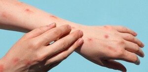 Sarampión síntomas y cómo se contagia.