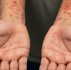 una persona muestra sus brazos y manos con brotes de sarampión