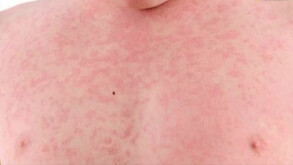 Autoridades sanitarias reportaron un incremento en casos de sarampión y tosferina a nivel nacional.