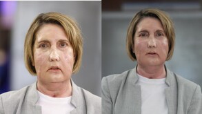 Mujer con primer trasplante de cara en Estados Unidos