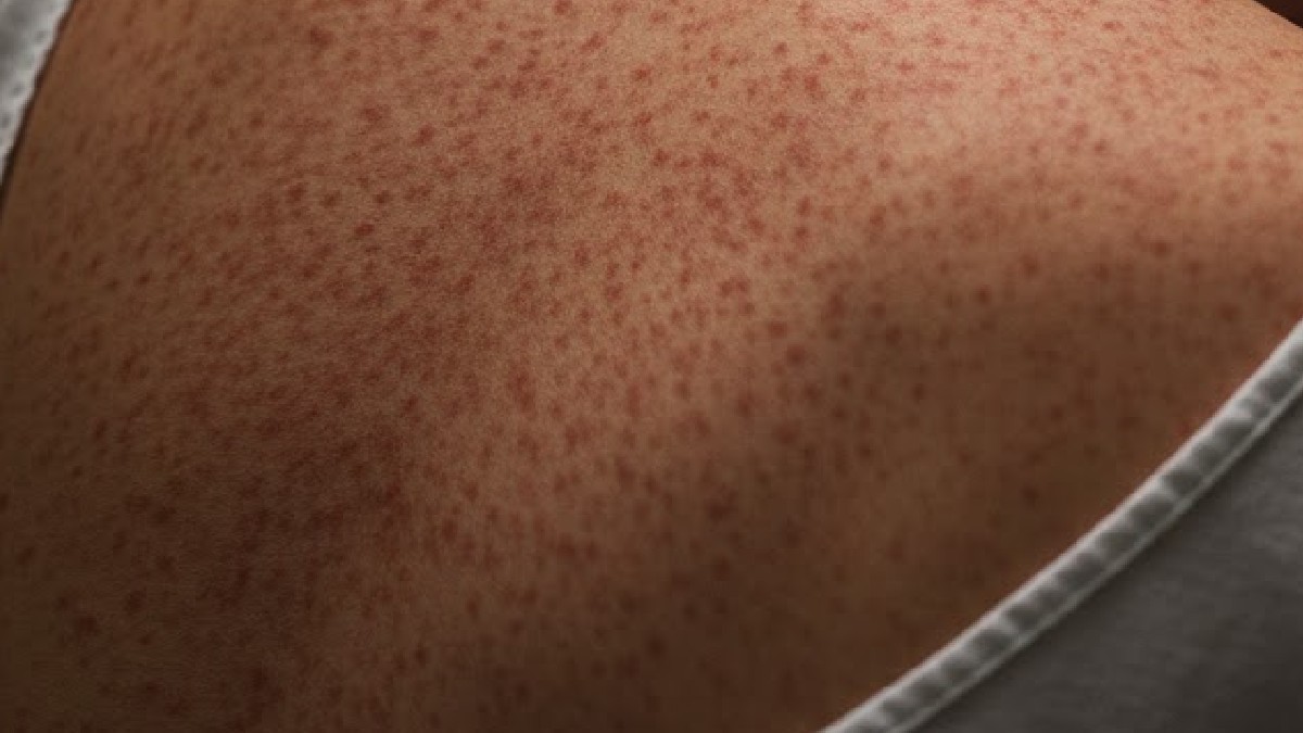 Espalda dañada por el sarampión