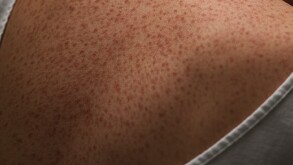 Espalda dañada por el sarampión