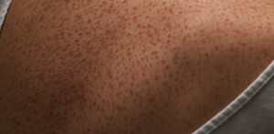 Espalda dañada por el sarampión