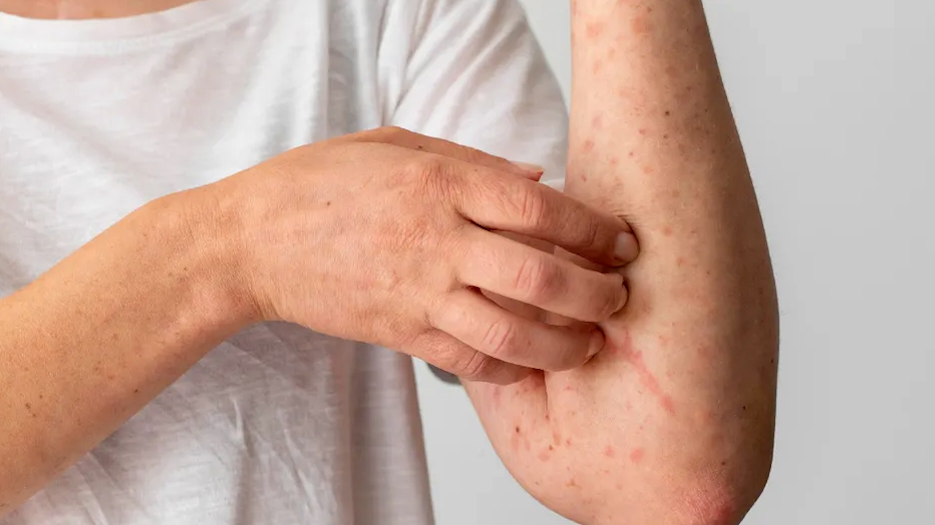 México enfrenta un repunte crítico de sarampión con 8,332 casos. Clara Brugada, Jefa de Gobierno, advierte que en CdMx el foco está en adultos de 20 a 49 años.