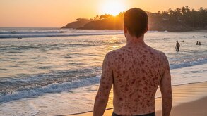 un hombre con manchas de sarampión en una playa