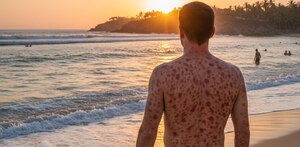 un hombre con manchas de sarampión en una playa